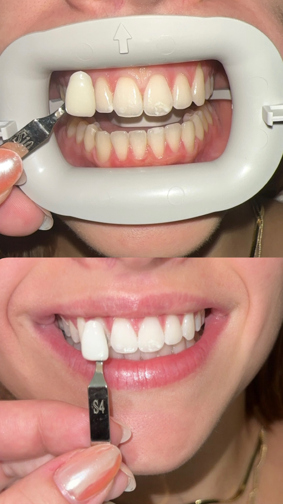 Teeth improvement results from professional cleaning
